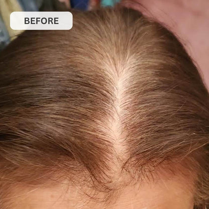 Kiierr Laser Cap Hair Growth System