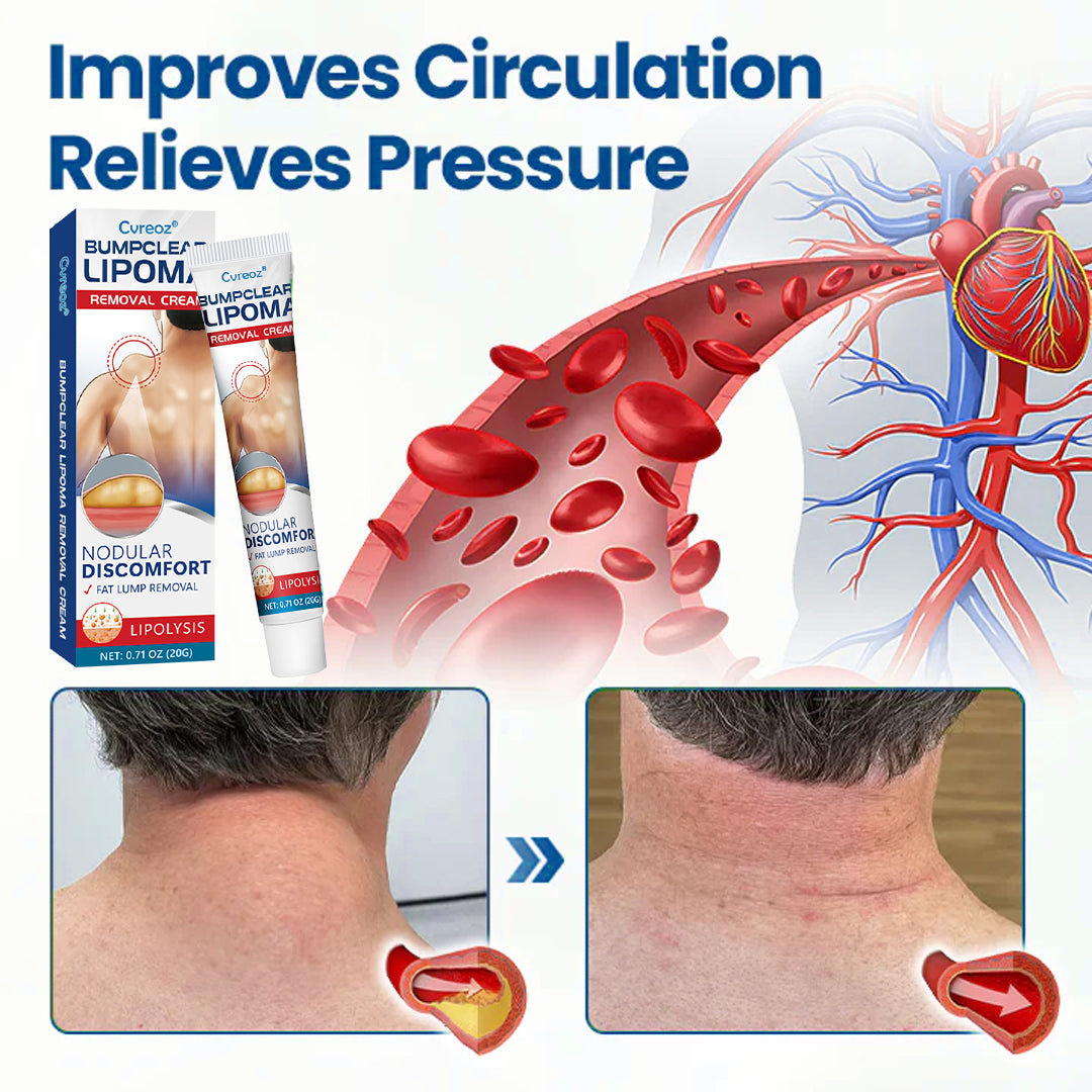 🎉SPECIAL OFFER: 60% OFF This Today Only!🔥Cvreoz® BumpClear Lipoma Removal Cream