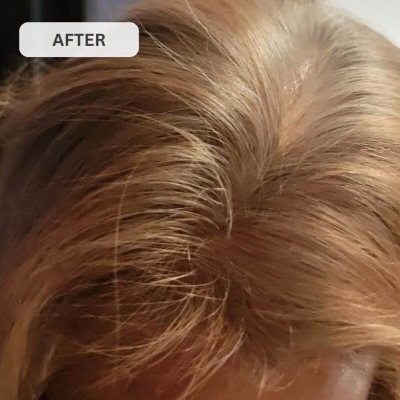 Kiierr Laser Cap Hair Growth System