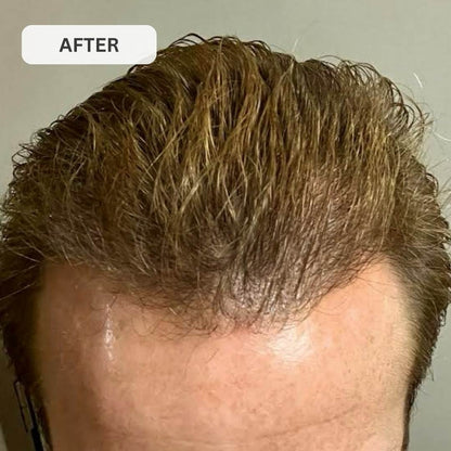 Kiierr Laser Cap Hair Growth System