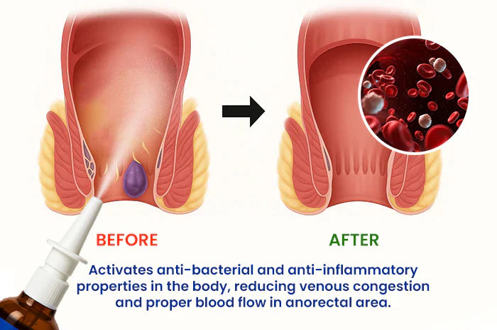 Cvreoz® Herbal Hemorrhoid Treatment Anal Spray🌟 Instant Soothing Relief🌟