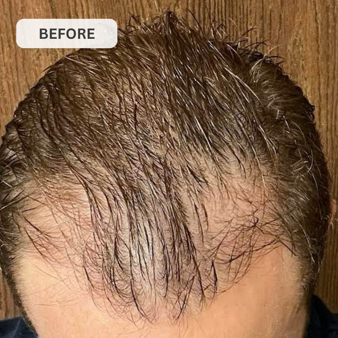 Kiierr Laser Cap Hair Growth System